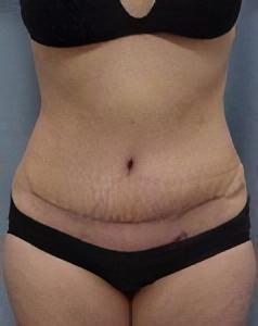 after tummy tuck