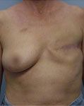 before breast reconstruction