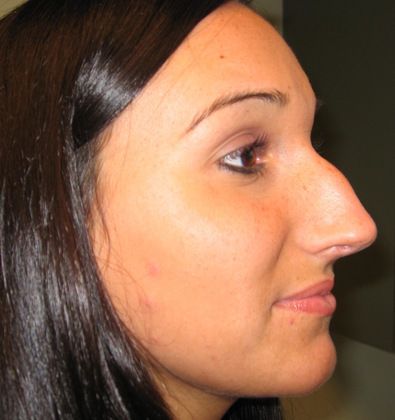 before rhinoplasty