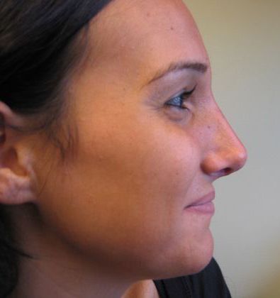 after rhinoplasty